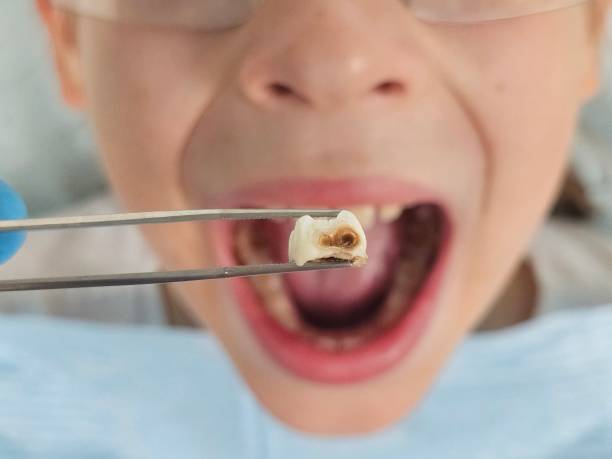 Best Emergency Wisdom Tooth Extraction in Celoron, NY